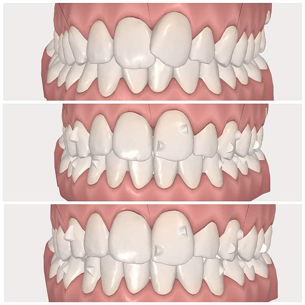 ClinCheck de Invisalign